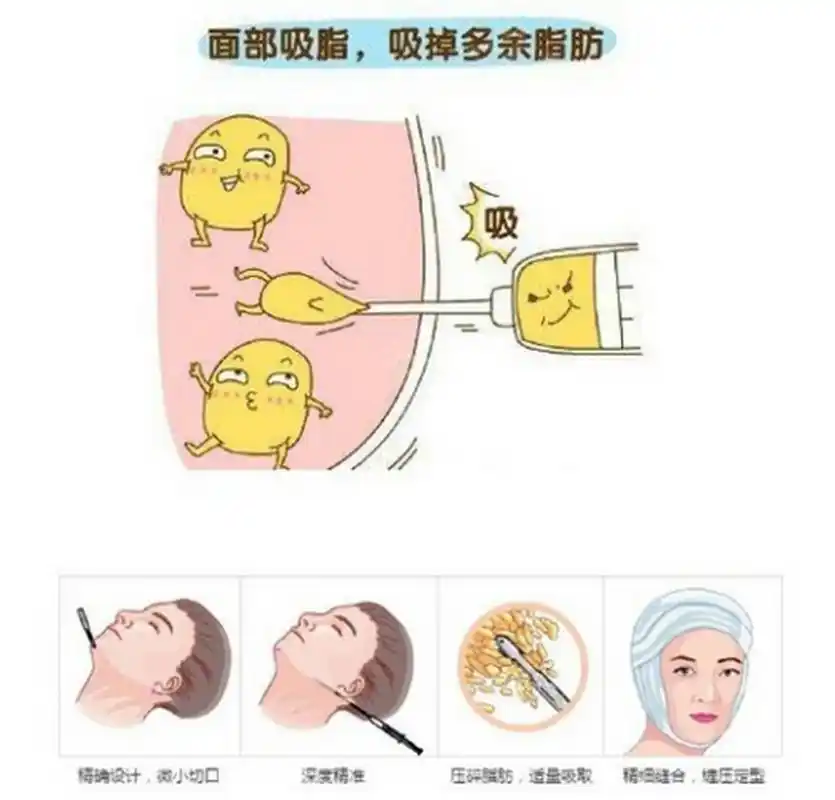 首先,吸脂瘦脸是通过去除脸部多余的脂肪细胞来达到瘦脸效果的