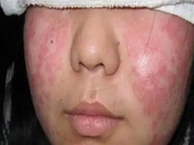 银屑病长在脸上还能好吗