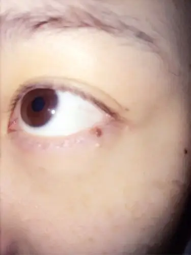 脂肪粒小小一个 怎么祛除?