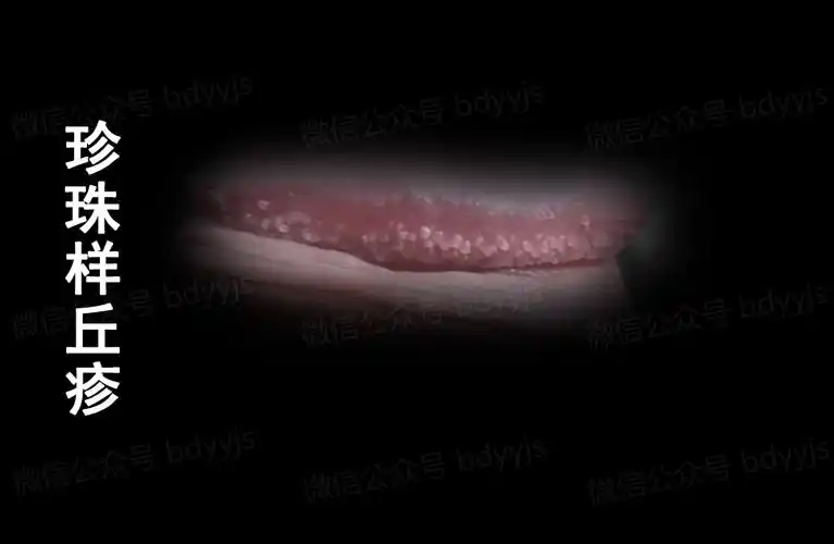 珍珠疹,又叫阴茎多毛样乳头瘤,阴茎冠状沟丘疹,龟头丘疹,毛状阴茎,多