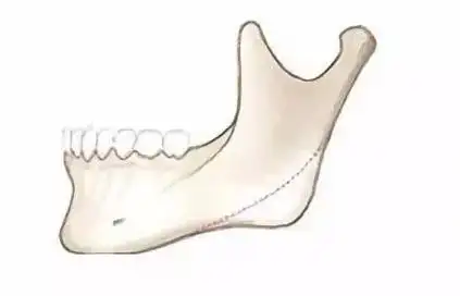 下颌骨截骨示意图