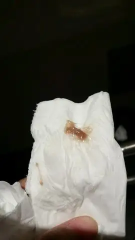 孕33周,出现褐色分泌物,正常吗?好担心