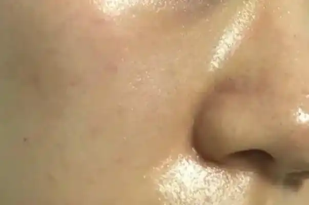 皮肤出油多是什么原因 皮肤出油严重毛孔粗大如何改善