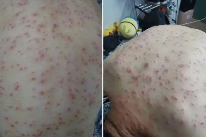 全身长满红色疙瘩,我仿佛变成了一个"毒人"|红疹|结痂|呼吸道|疹子