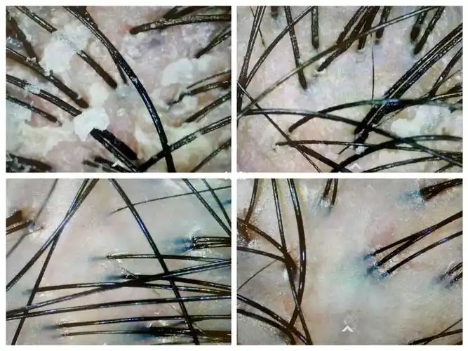 头皮上,是皮下菌体感染的代谢症状需清洁到位且用针对性的洗护精华改