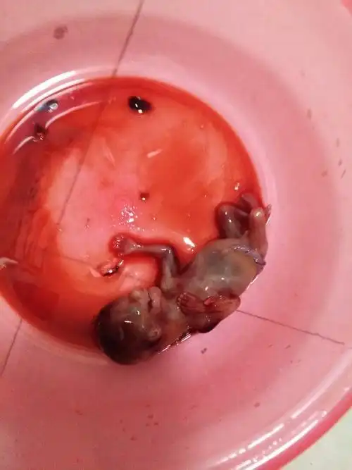 3个月胎儿引产下来图 引产什么意思 快生了引产是什么意思