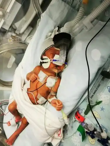 26周双胞胎宝宝提前降临