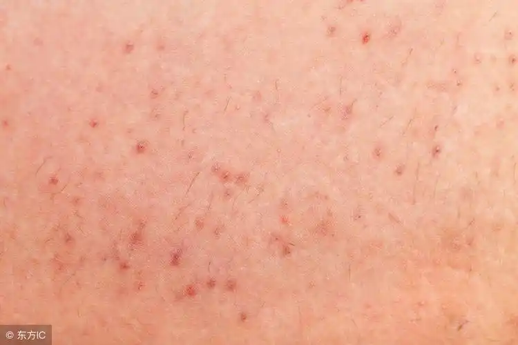 毛囊炎的图片如何辨别毛囊炎有什么预防注意事项