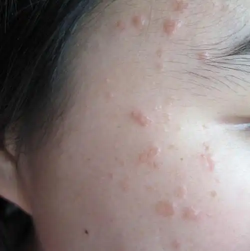 扁平疣形状图片