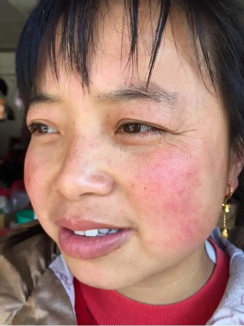 七老董茵修复激素脸  #问题性皮肤管理  #红血丝  #解 - 抖音