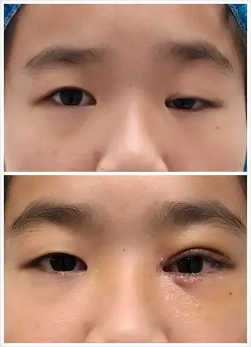 提肌无力重度上睑下垂术后"露白"情况 - 好大夫在线