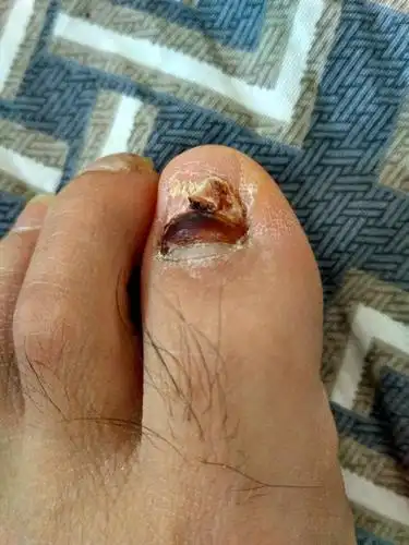 洗涨时用手扣过指甲里边的脏东西,现在感觉没长出来的地方和扣过的地