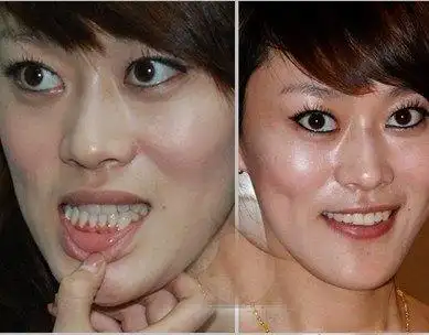 地包天矫正 - ybskq2014 - ybskq2014的博客