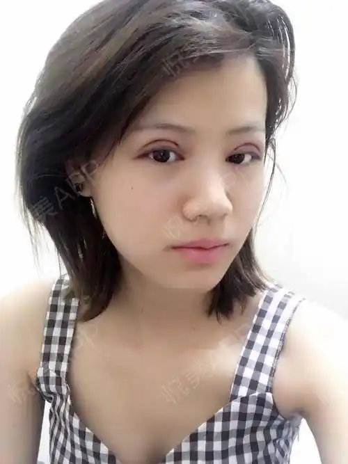 全切双眼皮术后1天_双眼皮术后1天_眼部整形术后1天_悦mer_0839514808