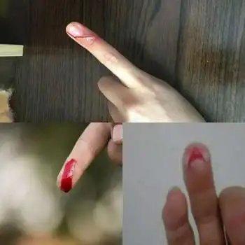 手指流血的图片