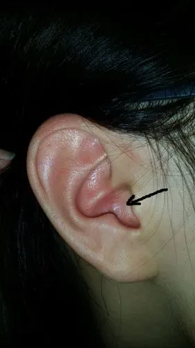 耳廓里面长了个硬包,早上起来发现耳朵里胀胀的和微微痛.