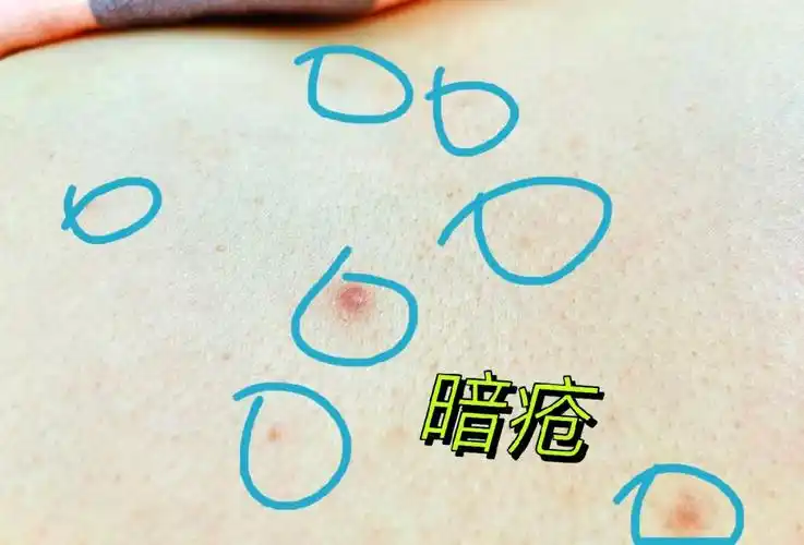 暗疮暗疮胸部暗疮