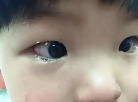 5岁宝宝眼睛"看不见了",家人以为没睡好,检查后医生:来晚了