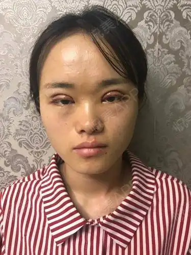 全切双眼皮术后4天_眼部多项术后4天_双眼皮术后4天_眼部整形术后4天