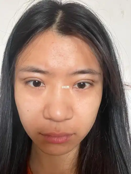 这也有点丑吧p62s图一是美颜 图二是原相机#埋线双眼皮恢复  #双