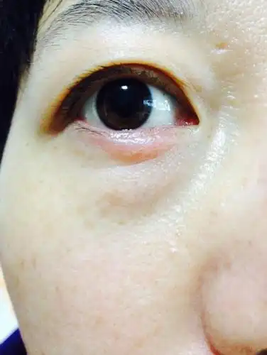 眼皮莫名水肿