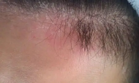 我头皮是得什么病了?有图