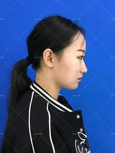 驼峰鼻还是这么好看,而我的就不行,感觉看起来太硬朗了,侧面看非常怪