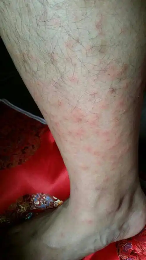 双腿起了好多包,红红的,像是被蚊子咬了