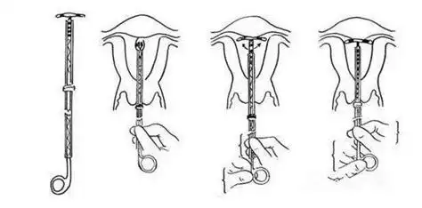 取环是怎样的过程