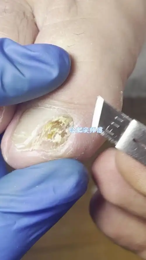 指甲里面长虫子了