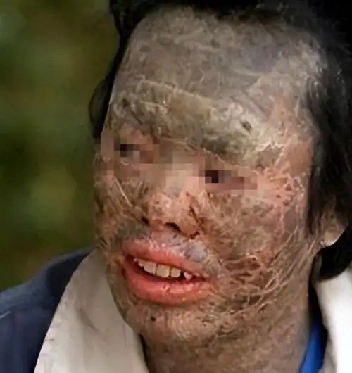 没想到吃完后全身长满了鳞片,活脱脱的变成了"蛇人"