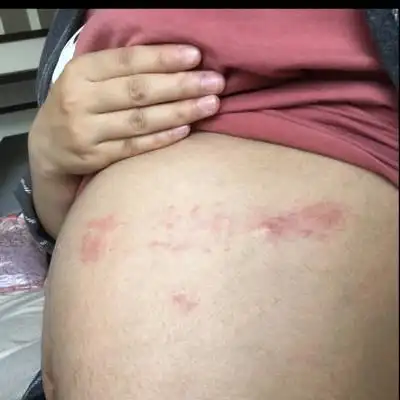 怀孕九个月,肚子上突然起了很多红的,偶尔会痒,但摸着会有点刺痛,到底