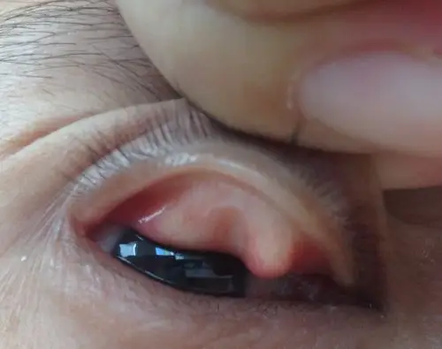 上眼皮里长了个包,感觉磨的眼球,这是长的什么?