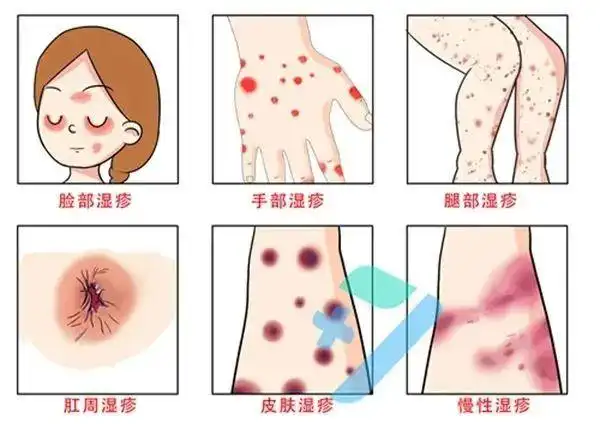 郑州肤康皮肤病医院湿热天气皮肤湿疹进入高发期这份治疗指南