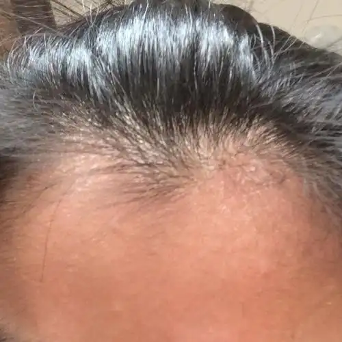 冬天头皮屑多的啊……为什么啊……怎么去除啊……好丑啊我的天