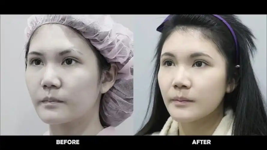 台中教主医美整形外科诊所bishopclinic - 自体脂肪丰额头手术 台中