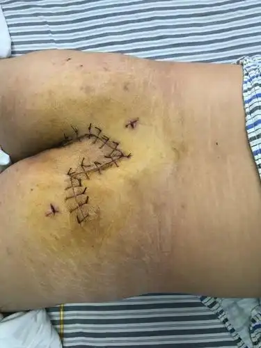 一例藏毛囊肿切除limberg皮瓣转移术