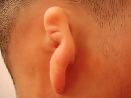 孩子生下来没有耳朵是怎么回事续