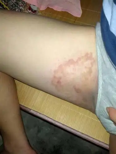 问:大腿内侧很痒,,到睡觉时特别痒,抓完后会留下一片暗红色的痕迹