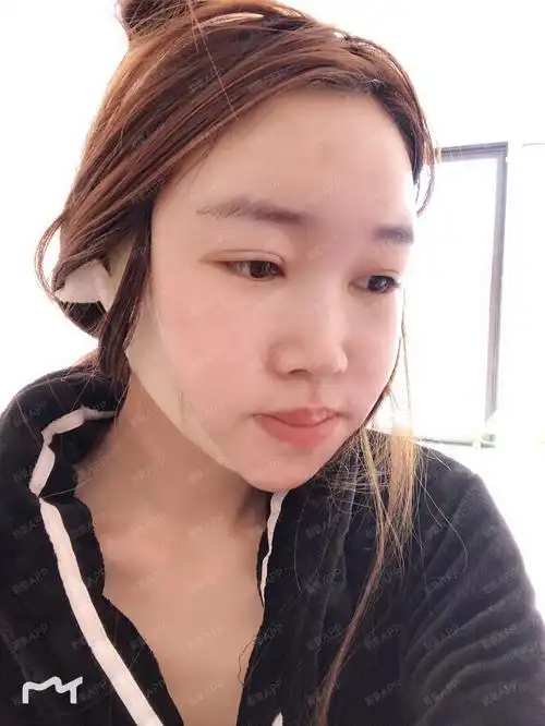 【自体脂肪全面部填充术后第4天】