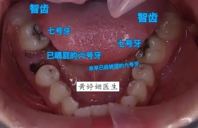 智齿变废为宝.上半口的照片,我就不放了 下半口:已经整齐的下 - 抖音
