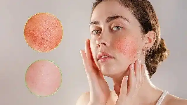 关于敏感肌,你的理解可能是错的_皮肤过敏_介绍_日常注意事项 - 好