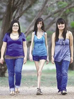 揭秘世界最瘦骷髅女孩,体重仅26公斤