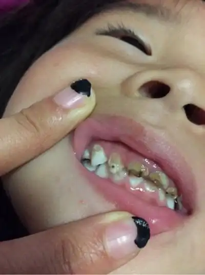 三沙市龋齿医院_三沙市治疗龋齿哪家医院好_三沙市治