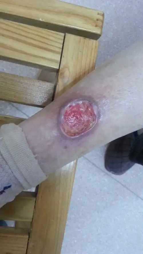 这是一个86岁老人的腿,由于30多年的糖尿病,老人的腿经常会发炎,溃烂.