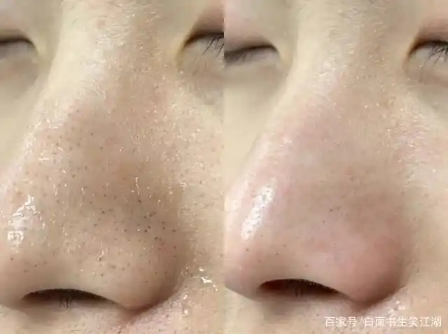 亲测有效去黑头宝藏单品!从此告别草莓鼻!