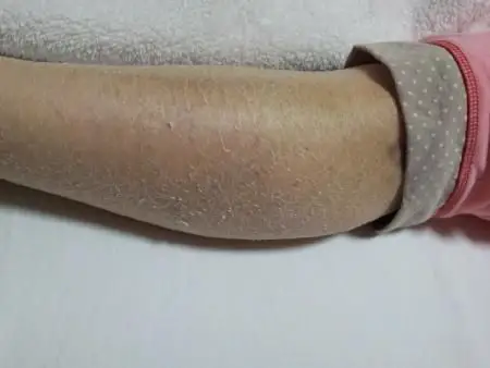 目睹全身爆皮的女人