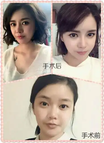 清潭优假体隆鼻_韩国整形日记_韩国整容前后对比照片_韩国整形后记