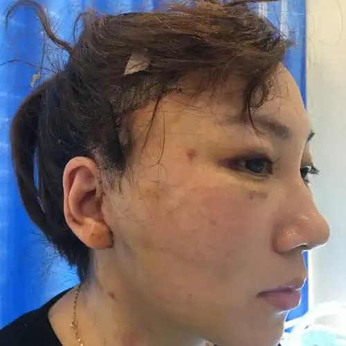 面部的神奇变化,迷你拉皮术后七天