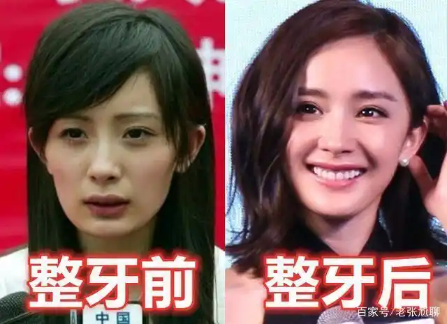 杨幂算是在牙齿整形前后差距相对来说比较大的女星了.